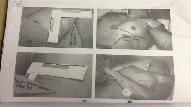 FATAL WOUND. Anikow was stabbed in the neck and kept bleeding until he pronounced dead a few hours later at Makati Medical Center. Photo from case file courtesy of the court clerk