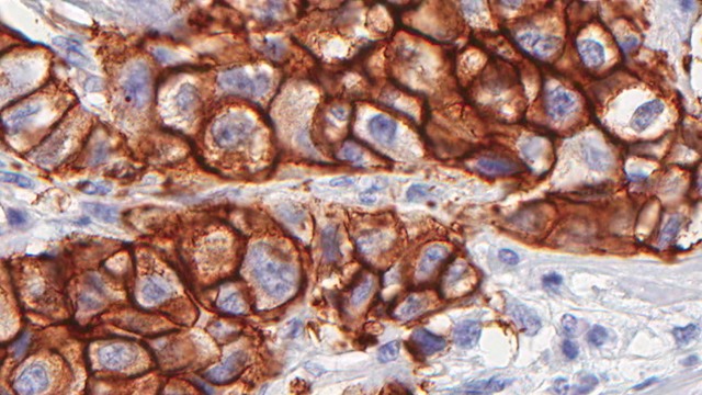 CANCER UP CLOSE. A scanned image of a breast carcinoma tissue stained to test for the presence of abnormal copies of the HER2 gene, viewed at 40x magnification. Quintiles Transnational handout/EPA/14 Sept 2009